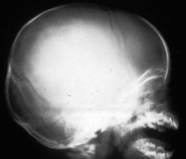 Lateral skull radiograph shows the importance of h
