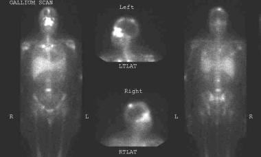 Neurosarcoidosis. Gallium scan "panda" sign: A gal