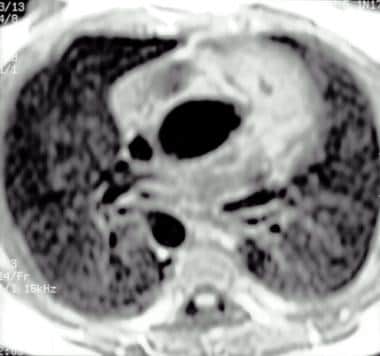 Magnetic resonance image of tetralogy of Fallot in