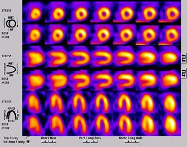 Normal perfusion on a single-photon emission compu