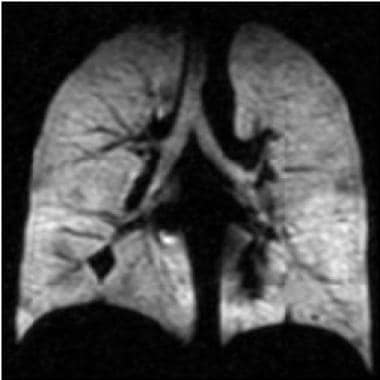 Asthma. Coronal hyperpolarized helium (He-3) MRI i