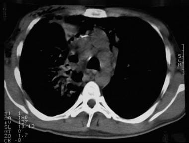 Thoracic histoplasmosis. Noncontrast chest CT imag