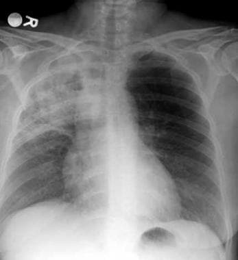 Lung cancer, small cell. Frontal chest radiograph 