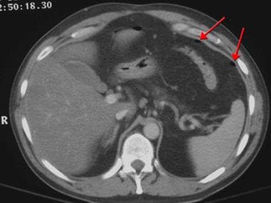 CT scan abdomen showing compression at D3 with dilated stomach and