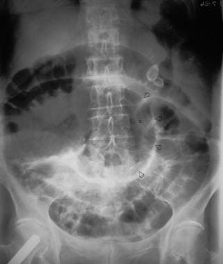 Plain supine abdominal radiograph from an 81-year-