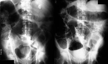 Left: Plain abdominal radiograph in a 58-year-old 