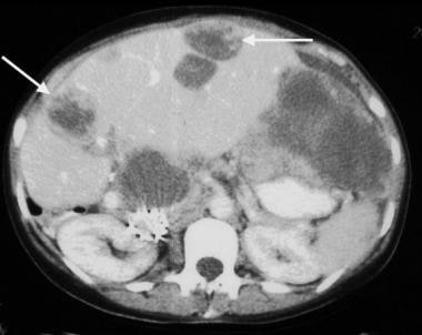 Gastrointestinal stromal tumor. Image obtained in 