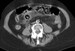 Mesenteric Ischemia Imaging