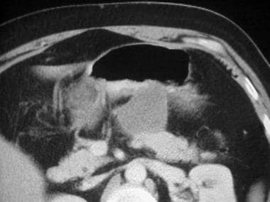 CT image of a pancreatic pseudocyst shows that it 