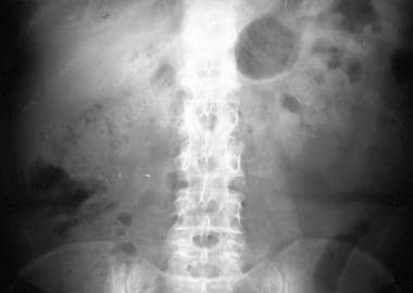 Plain abdominal radiograph in a 50-year-old woman 