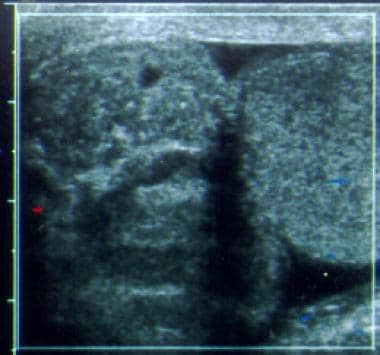 Testicular torsion. Longitudinal color Doppler ima