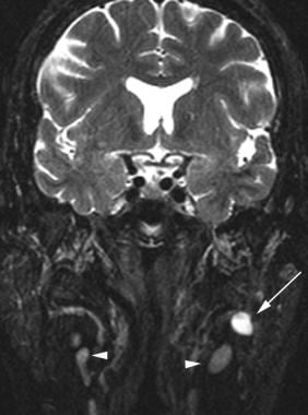 Coronal fat-saturated T2-weighted MRI demonstrates