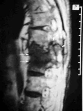 Pseudoarthrosis. Sagittal T1-weighted MRI shows a 