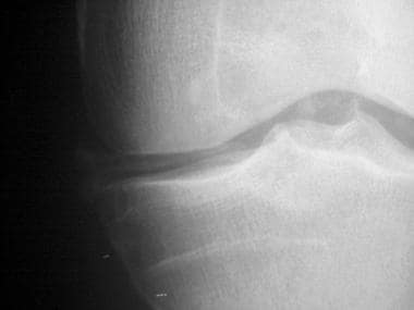 Magnified anteroposterior radiograph of knee demon