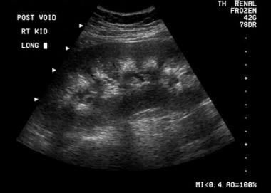 Sonogram of the kidney in a patient with primary h