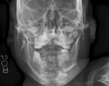 Anteroposterior radiographic image shows a right r