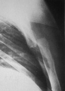 Lateral radiograph demonstrates complete dislocati