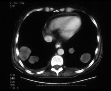 A 57-year-old woman with stage IVB poorly differen