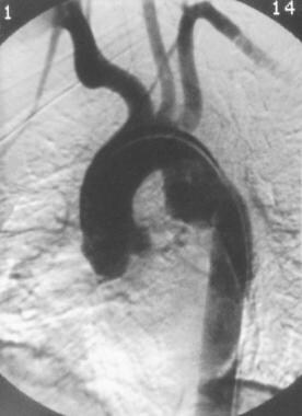 Aorta, trauma. Left anterior oblique (45°) angiogr