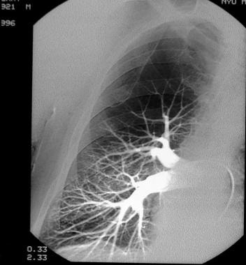 Pulmonary angiography. Digital subtraction pulmona