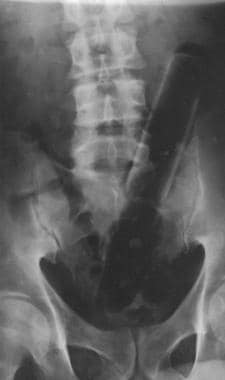 Rectal foreign body readily visible on radiography