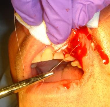 Placement of intraoral skin suture with buried kno