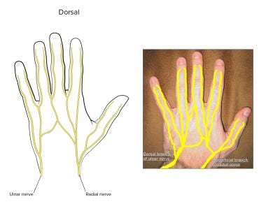 Median Nerve Block: Overview, Indications, Contraindications