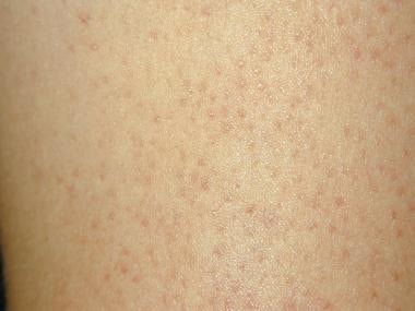 hyperkeratosis pilaris