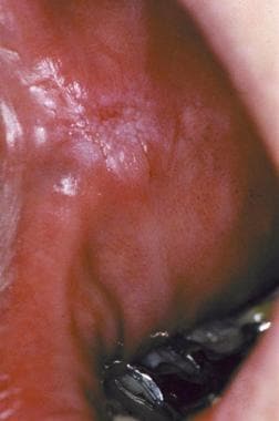 Lichen planus–like lesion adjacent to a dental res