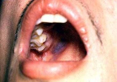 Oral Kaposi sarcoma. 