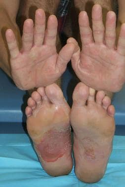 Dyshidrotic eczema (pompholyx). Palms and soles of