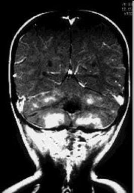 MRI of a patient with symptoms of gait unsteadines