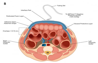 Temporary Abdominal closure after Laparotomy. Zipper System 