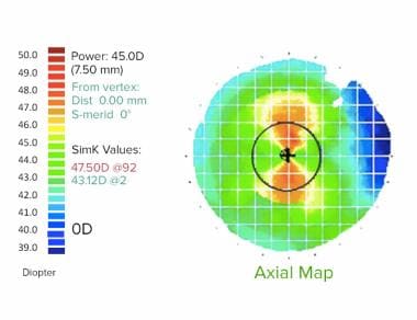 Laser Assisted Subepithelial Keratectomy Lasek Treatment - example of placido based corneal topography this