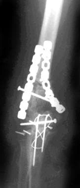 Radiograph of a supracondylar-intracondylar humeru