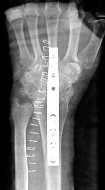 Wrist arthrodesis. Radiograph of patient after wri