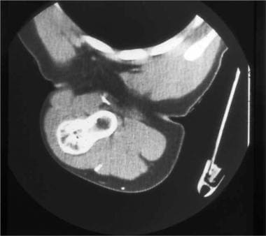 Solitary osteochondroma. CT scan of the same sessi