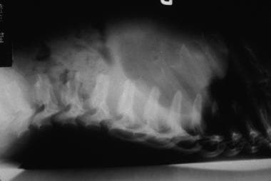 Hurler syndrome; lateral radiograph of thoracolumb