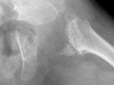 spondyloepiphyseal dysplasias