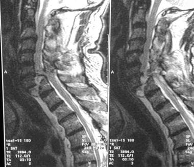 MRI of C7-T1 fracture/dislocation. 