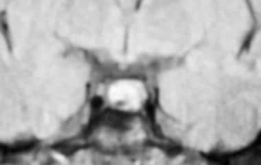MRI showing a nonenhancing area in the pituitary c