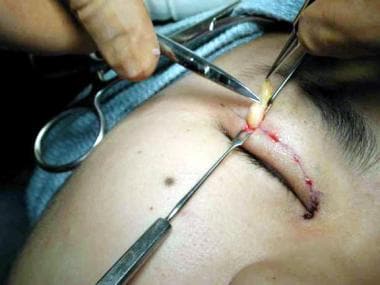 Remove thin slivers of tissue, going through orbic