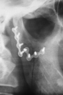 Mandibular fracture. Close-up view of postoperativ