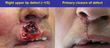 Left: Right upper lip defect (~1/3). Right: Primar