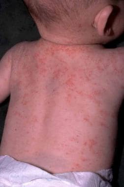 Wiskott-Aldrich综合征的湿疹病变。TH.