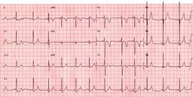 This 12-lead electrocardiogram (ECG) is from an as