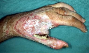 The hand is healing following aggressive surgical 