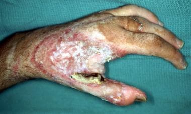 Streptococcal toxic shock syndrome revealed phlegmasia cerulea dolens of  the arm - The Lancet Infectious Diseases