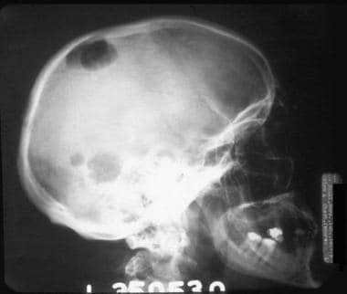 Radiograph of the skull demonstrating a typical ly