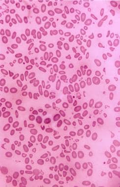 Peripheral smear that shows evidence of hereditary